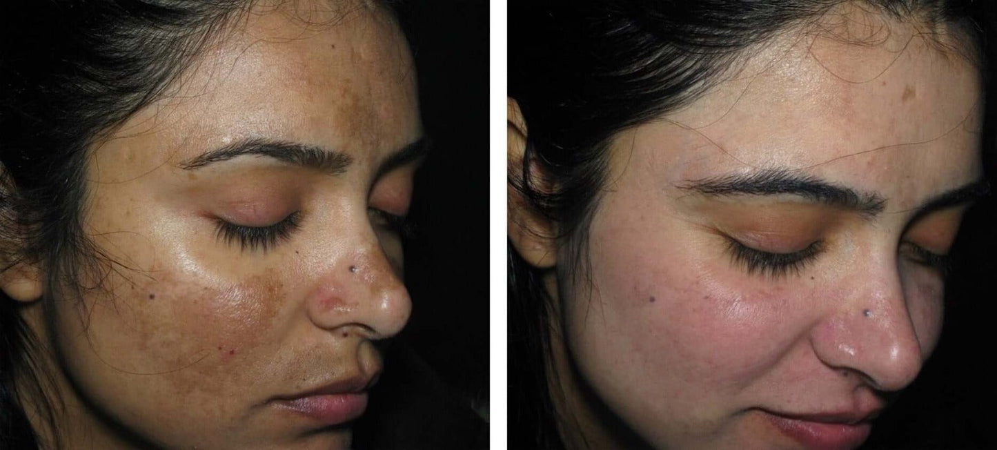 Pigmentation Combo For All Skin Types (5 Items)